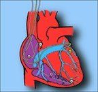 бивентрикулярный стимулятор