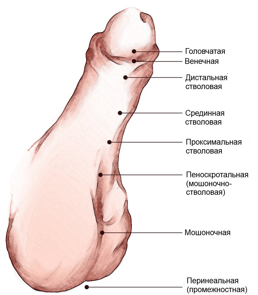 формы гопоспадии